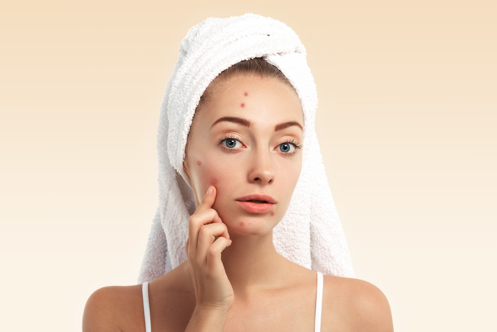 Salicylic Acid dan Benzoil Peroksida: Mana yang Lebih Ampuh untuk Jerawat?